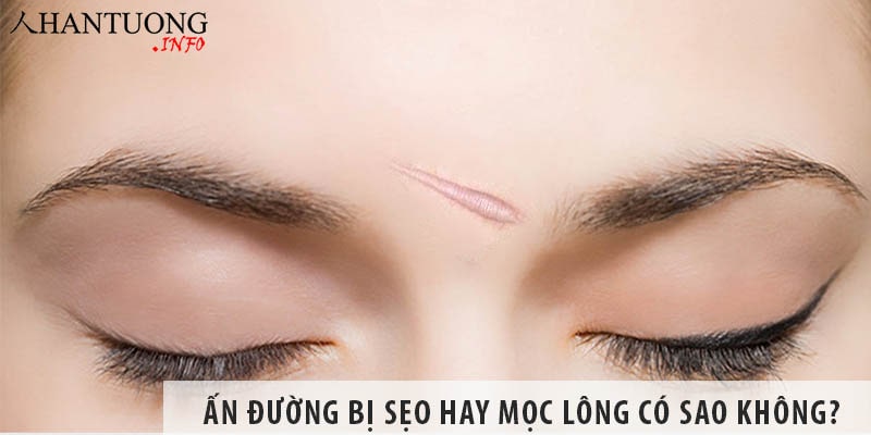 Ấn đường bị sẹo hay mọc lông có sao không? Ấn đường bị sẹo hay mọc lông có sao không?