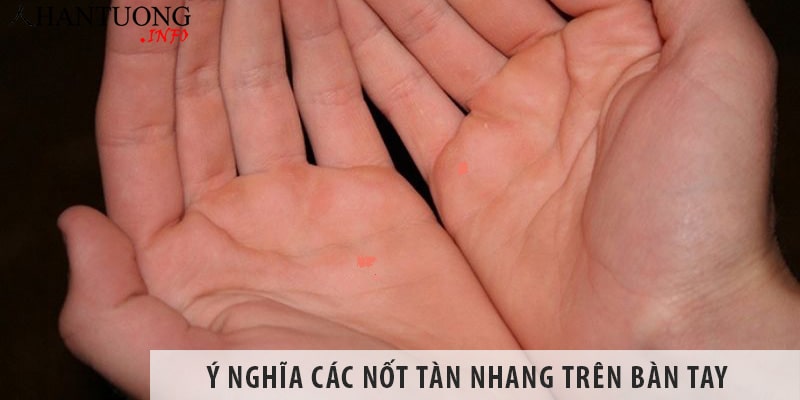 Ý nghĩa các nốt tàn nhang trên bàn tay Ý nghĩa các nốt tàn nhang trên bàn tay