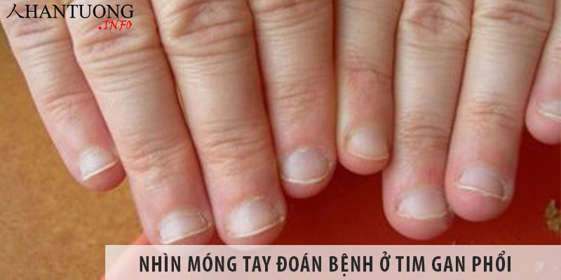 Nhìn móng tay đoán bệnh ở tim gan phổi Nhìn móng tay đoán bệnh ở tim gan phổi