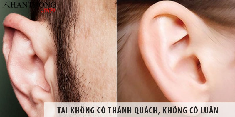 Tai không có thành quách, không có luân thì sao? Tai không có thành quách, không có luân thì sao?
